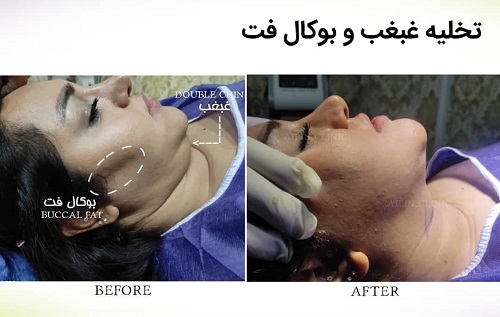 بهترین روش رفع غبغب | بررسی روش‌های بدون جراحی و با جراحی